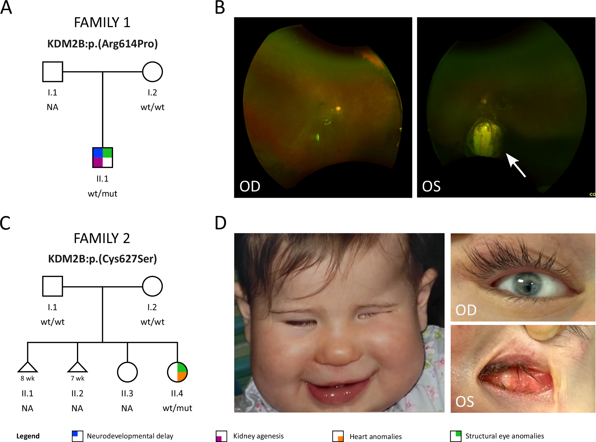 Fig. 1: Novel families with pathogenic KDM2B variants and structural eye anomalies.
