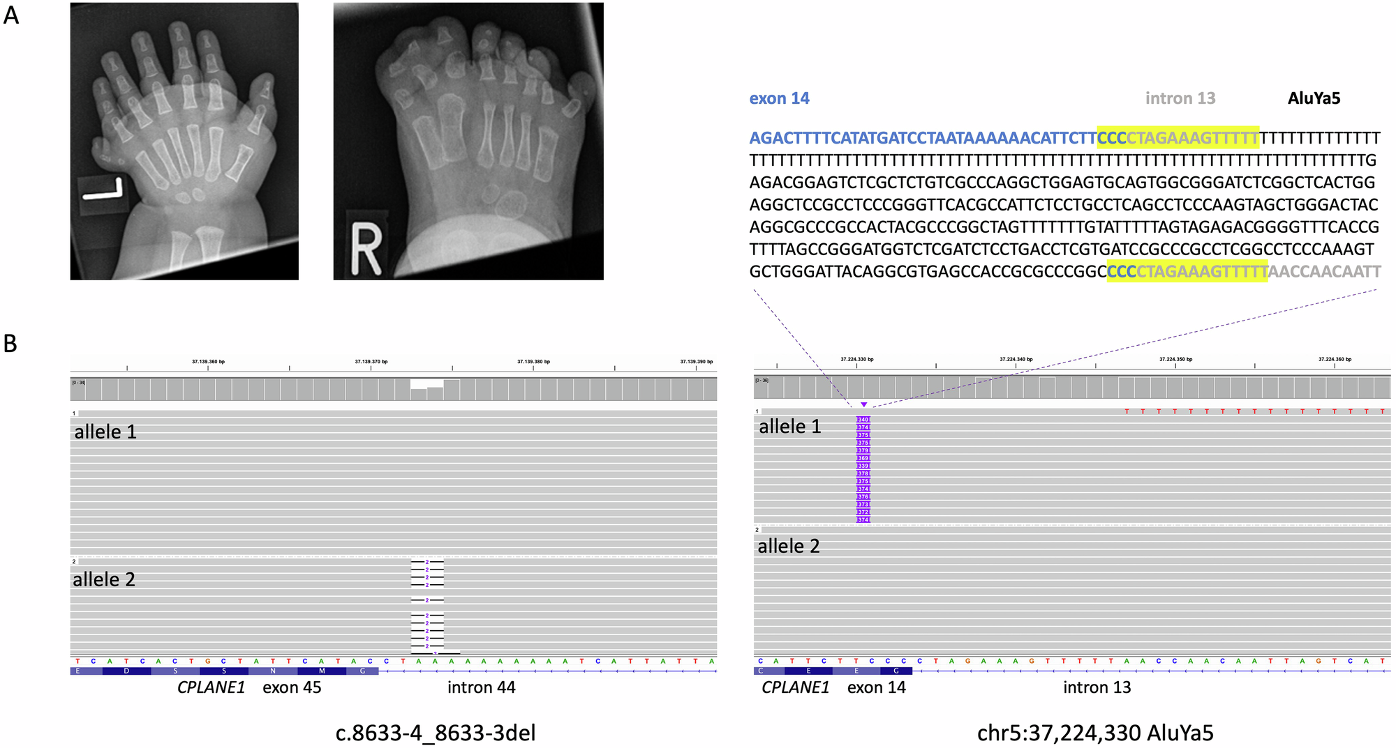 Long-read sequencing reveals a hidden Alu-mediated splice defect in CPLANE1 , causing orofaciodigital syndrome type VI