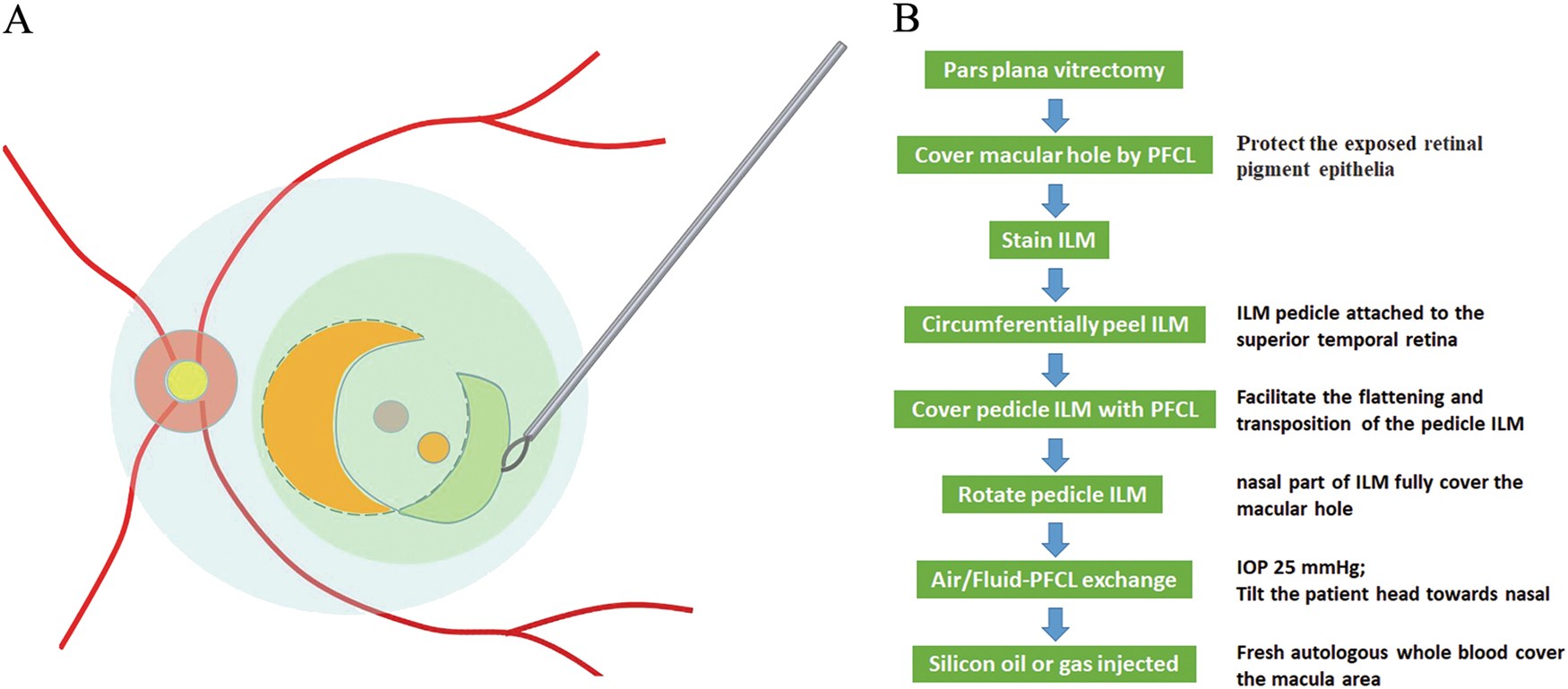 Non Inverted Pedicle Internal Limiting Membrane Transposition For Large Macular Holes Eye