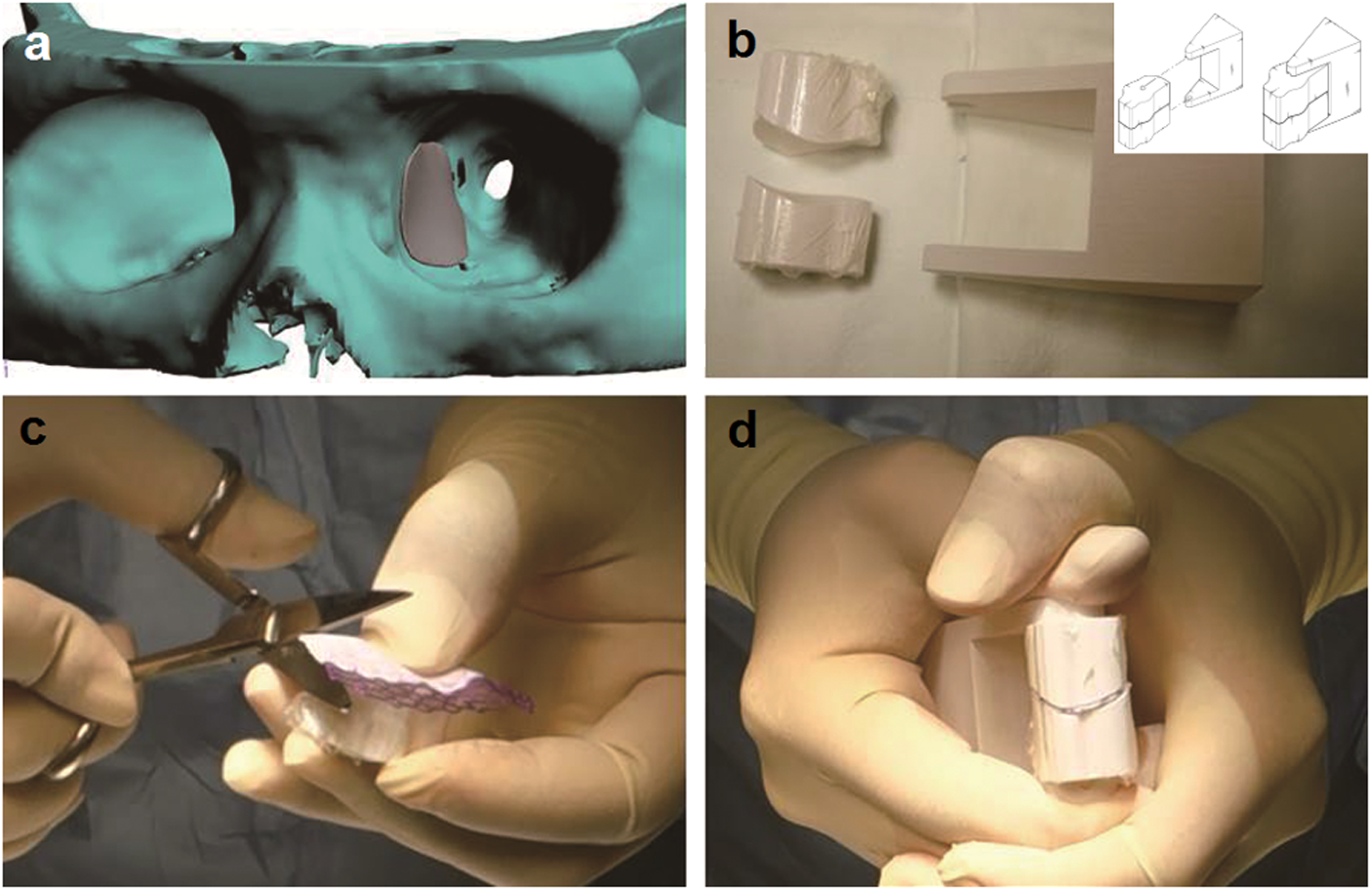 Generation Of Customized Orbital Implant Templates Using 3