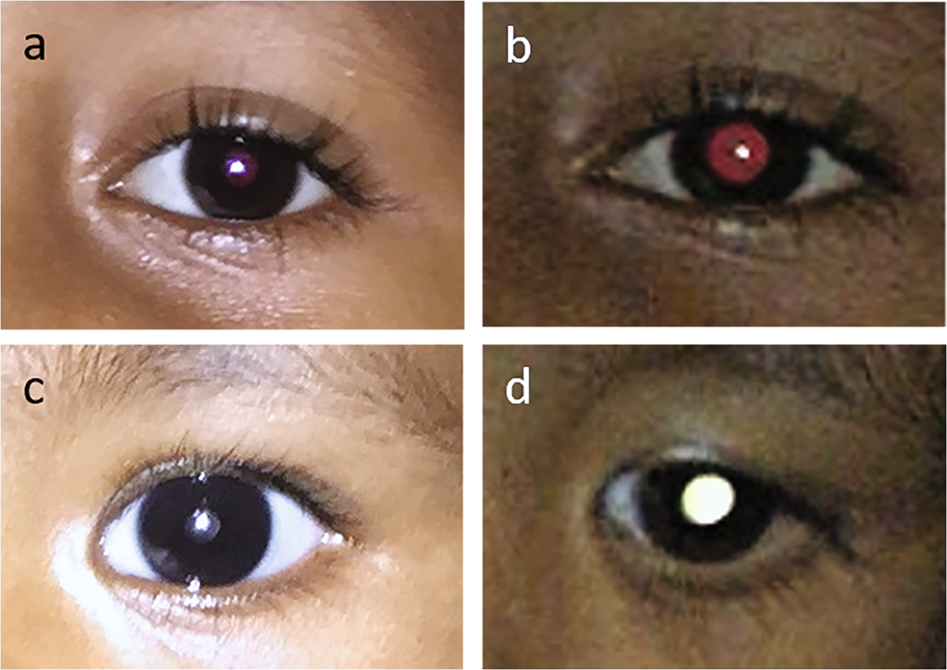 Smartphone-based application improves the detection of retinoblastoma | Eye