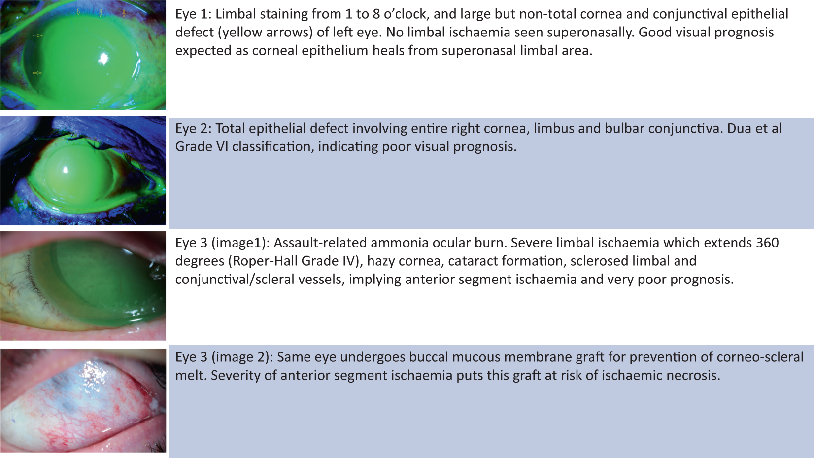 An update on chemical eye burns | Eye