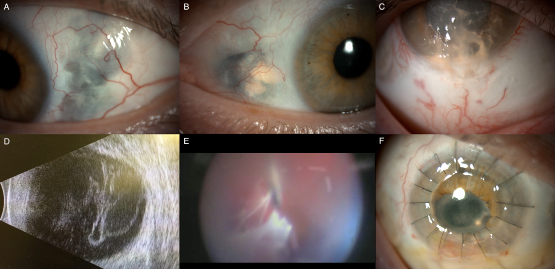 Self-tattooing of eyeball with inadvertent corneoscleral perforation: the implication of social media | Eye Self-tattooing of eyeball with inadvertent corneoscleral perforation: the implication of social media | Eye