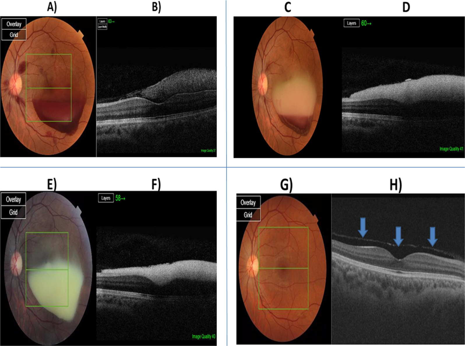 Tolperisone, a centrally-acting muscle relaxant: a possible cause of  macular haemorrhage | Eye