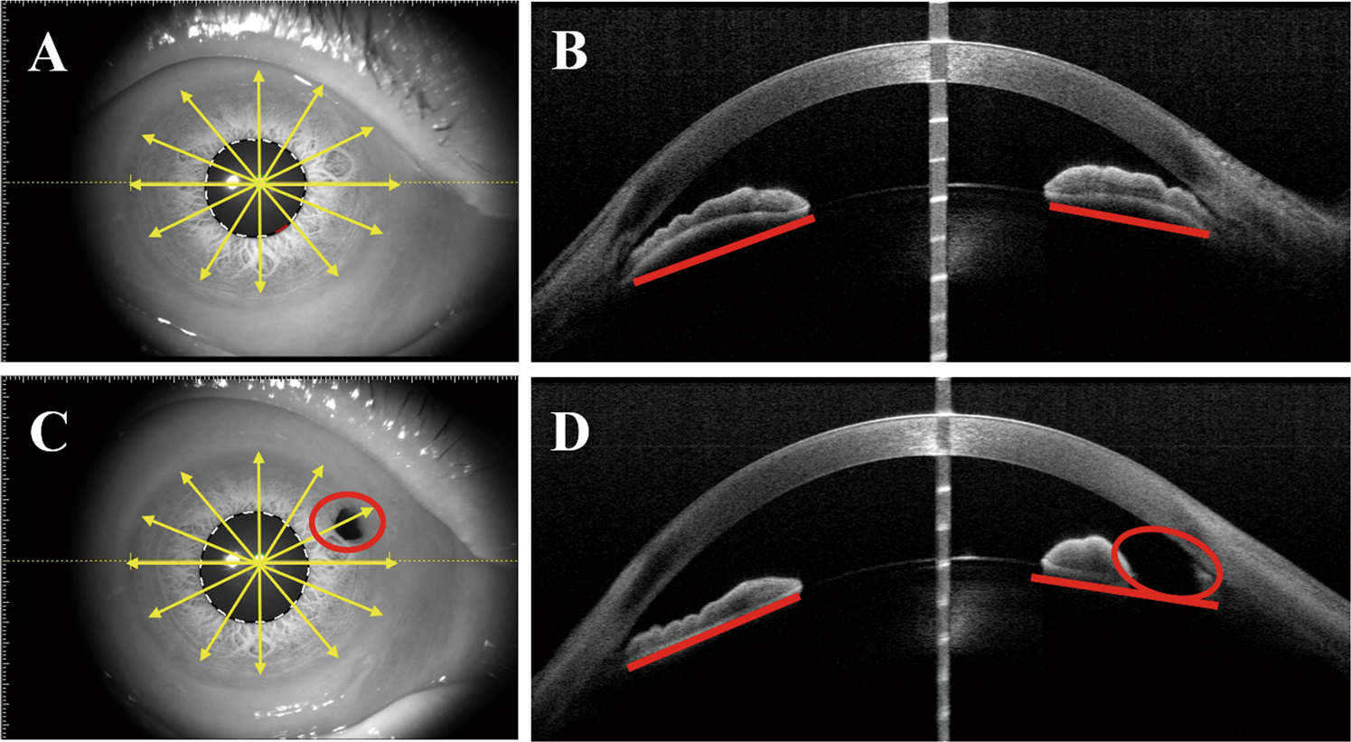 Clock position-based iris bow configuration after laser peripheral iridotomy  in Chinese angle closure eyes: a swept source optical coherence tomography  study | Eye