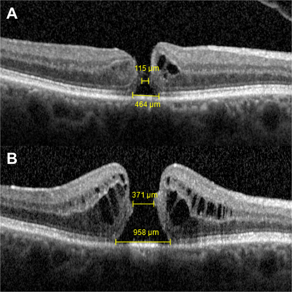 rate of progression of idiopathic full thickness macular holes before surgery eye