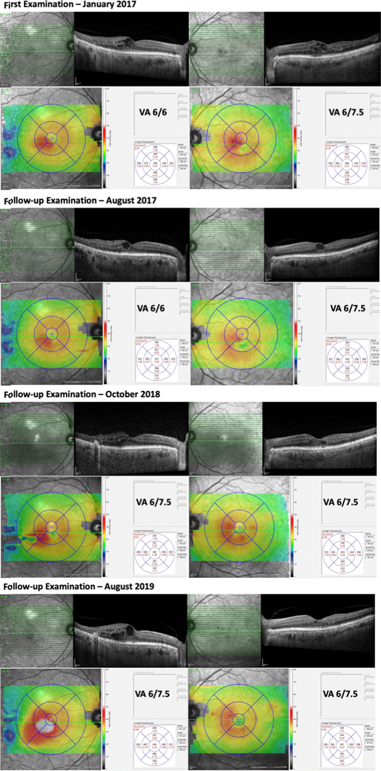 Macular Edema - Patients - The American Society of Retina Specialists