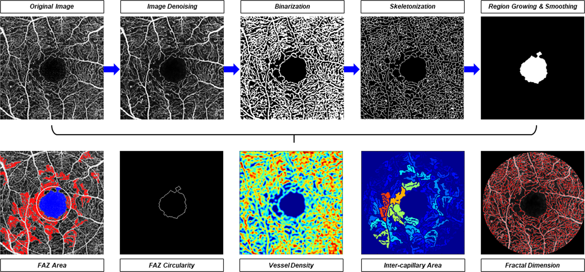 Optical Coherence Tomography Angiography In Diabetic Retinopathy An Updated Review Eye