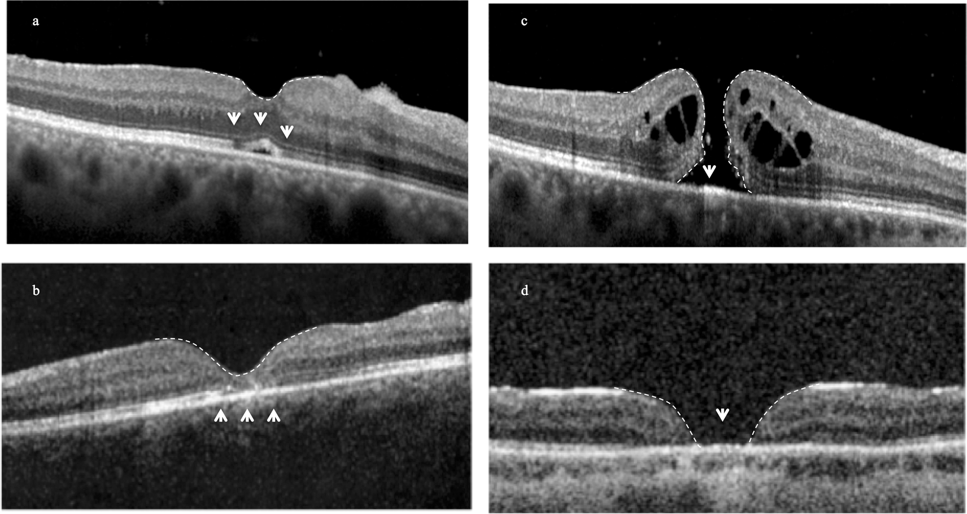 Refractory full thickness macular hole: current surgical management | Eye