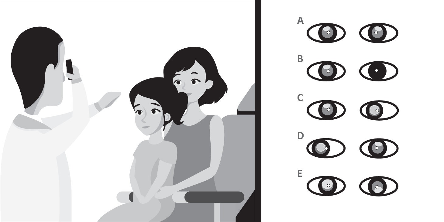 Identification Of Amblyogenic Risk Factors With The Bruckner Reflex Test Using The Low Cost Arclight Direct Ophthalmoscope Eye Identification Of Amblyogenic Risk Factors With The Bruckner Reflex Test Using The Low Cost Arclight Direct Ophthalmoscope Eye
