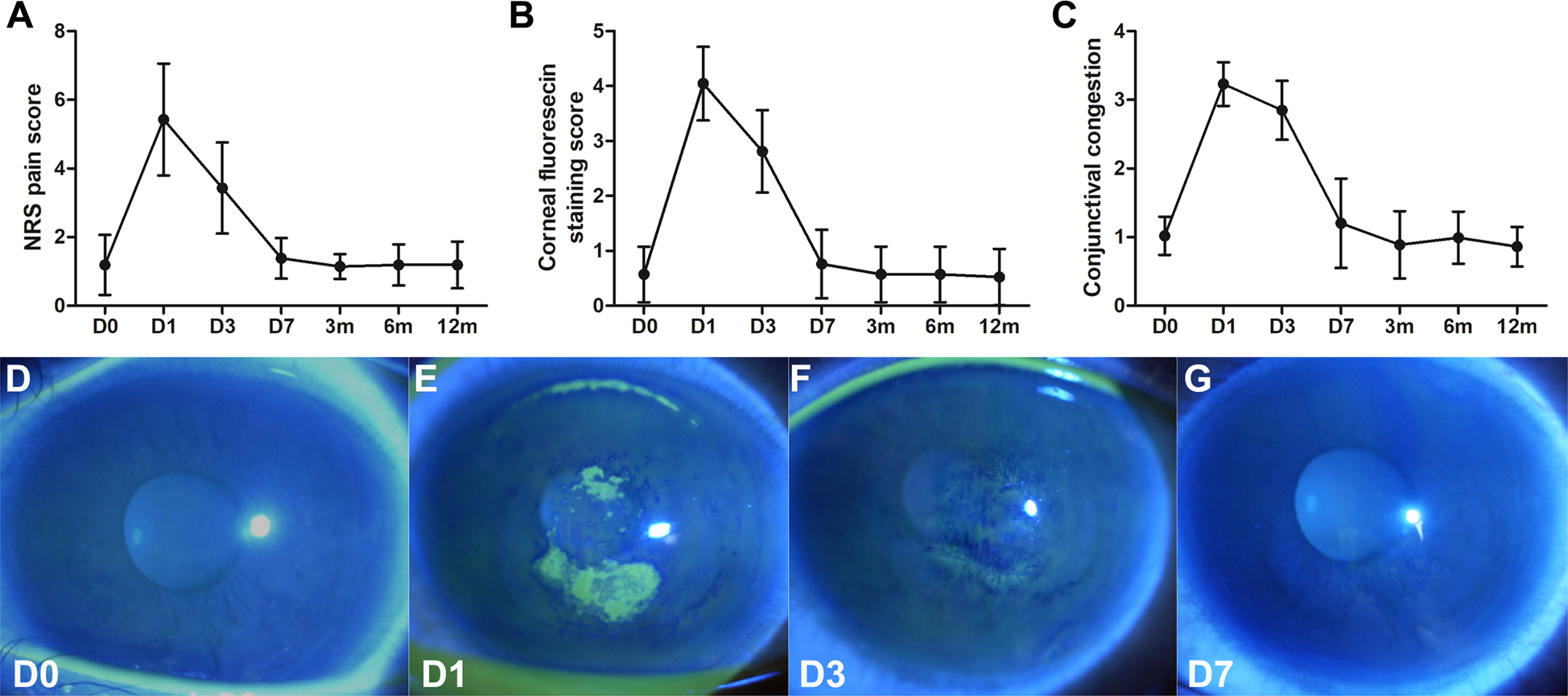 Fig. 1: Ocular discomfort and slit lamp observation after repeated CXL.