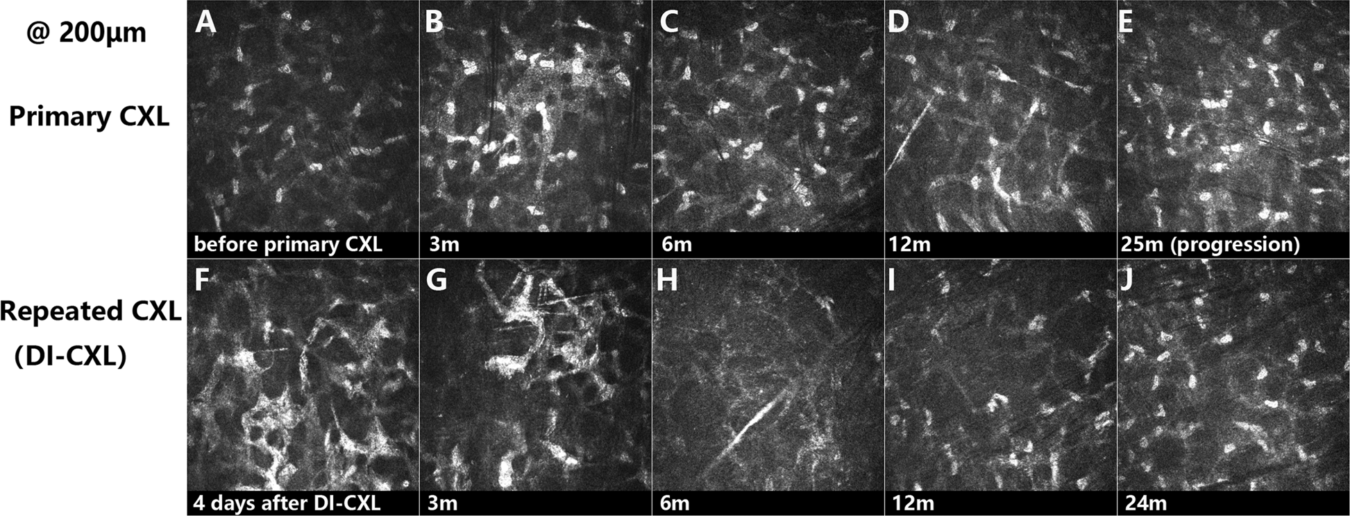Fig. 2: Representative images showing the structural alteration in the corneal stroma by in vivo confocal microscopy (800×).