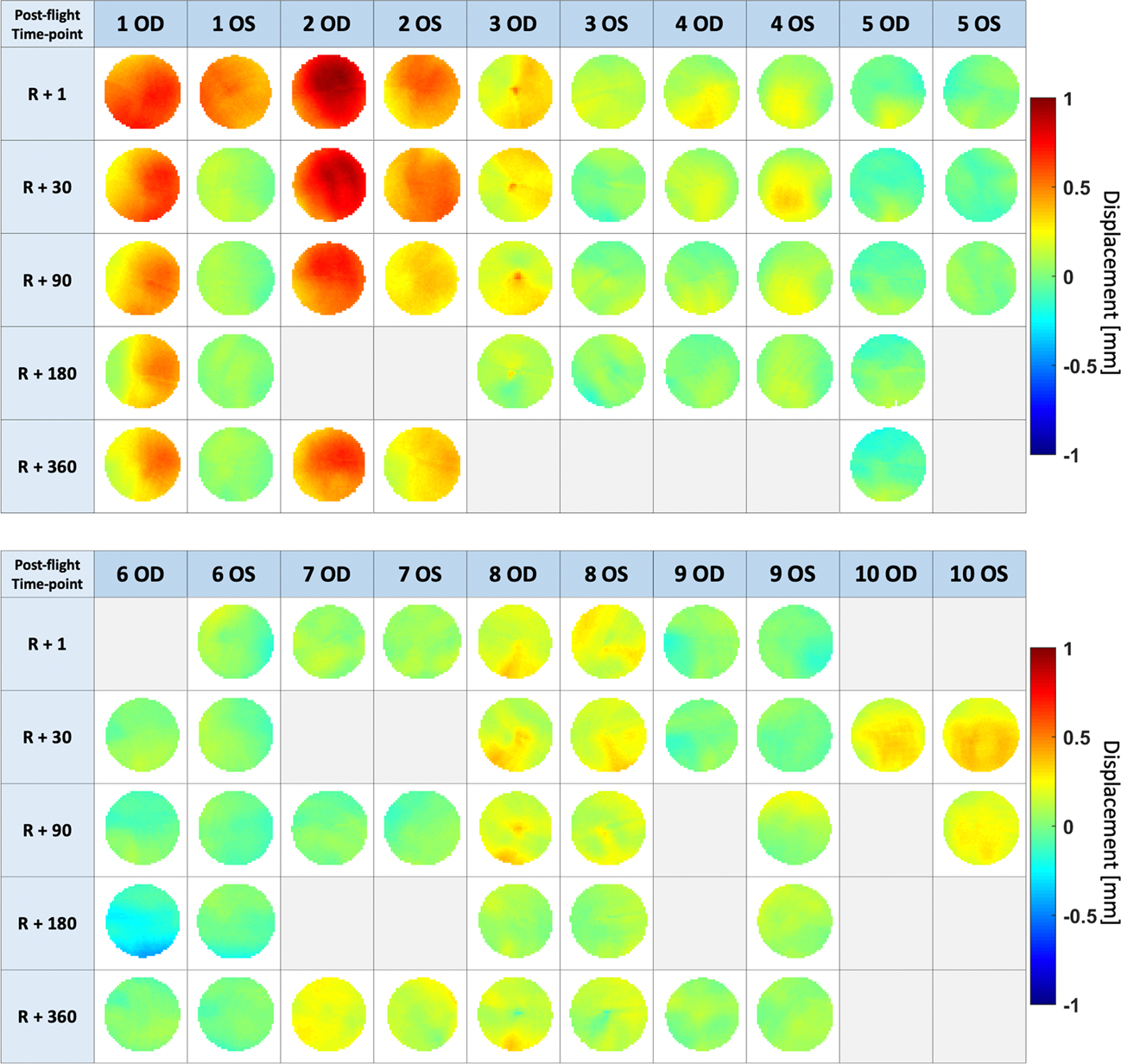 Fig. 3: Summary of all globe displacement maps for each subject (within a 4 mm radius around the optic nerve head) at multiple time points (R + 1, R + 30, R + 90, R + 180, and R + 360 days).
