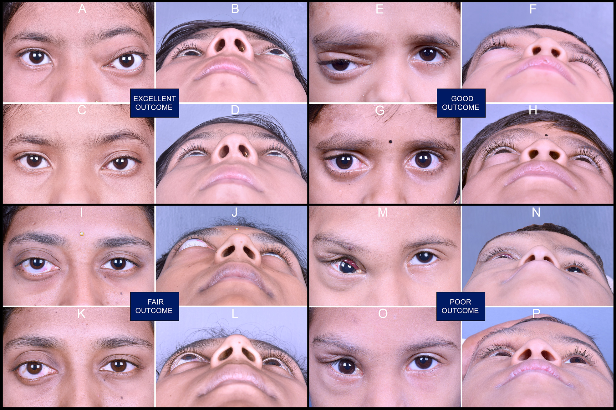 Management of Retrobulbar Lymphangioma Using Negative Pressure Aspiration  in a 14-Year-Old Female with a Long-Term Follow-Up: A Case Report | Journal  of Maxillofacial and Oral Surgery, image size:1969x1312