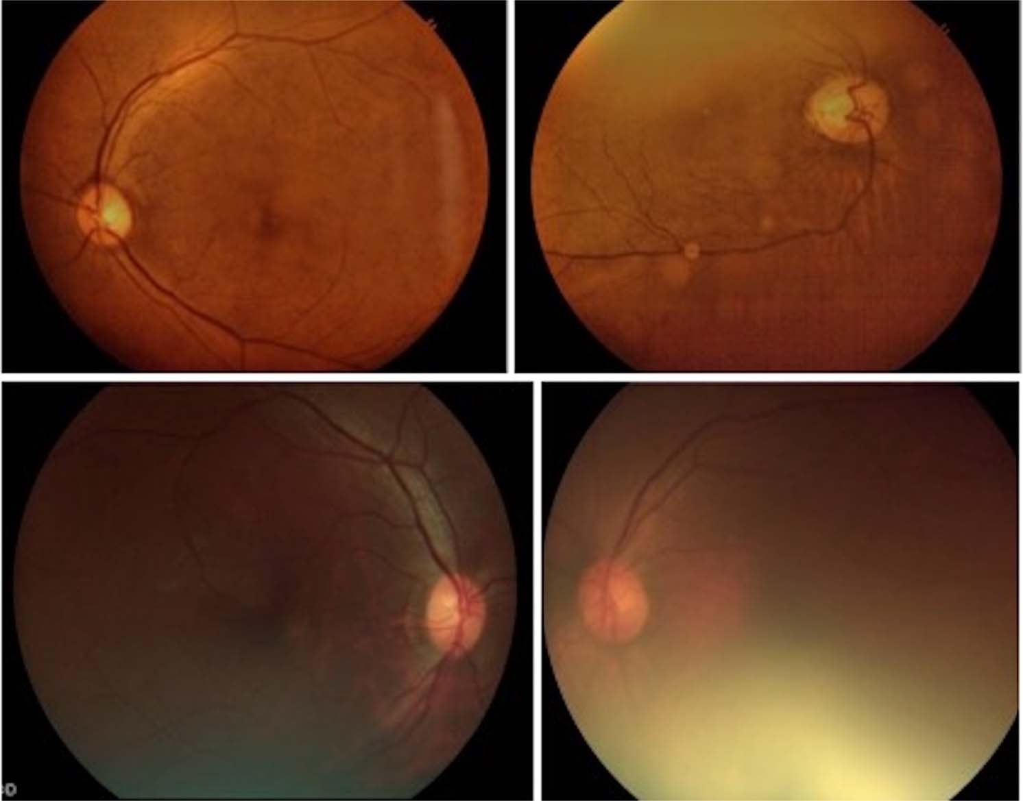 Recently Updated Global Diabetic Retinopathy Screening Guidelines Commonalities Differences And Future Possibilities Eye