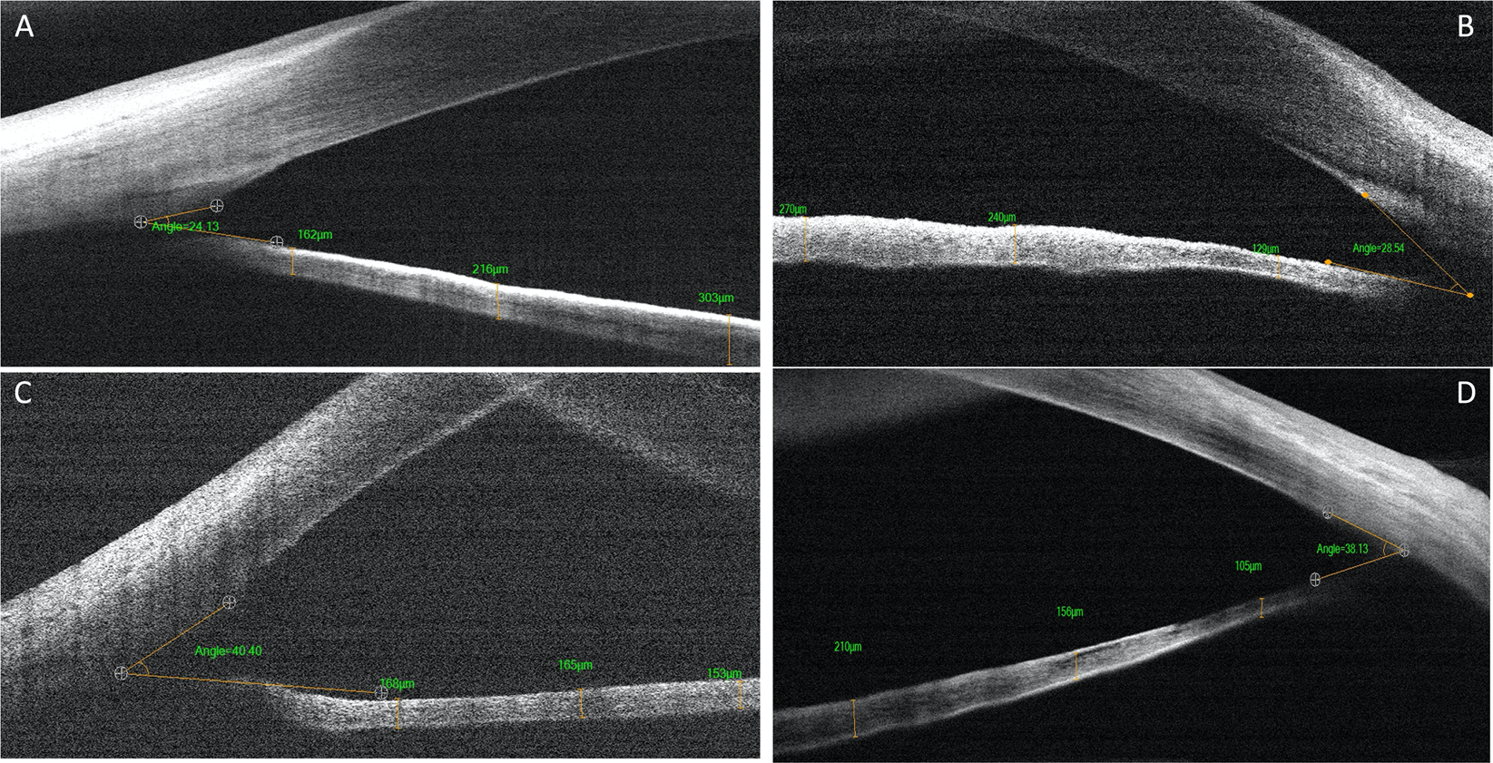 Anterior Chamber Angle Features In Primary Congenital Glaucoma Infants Using Hand Held Anterior Segment Oct Eye