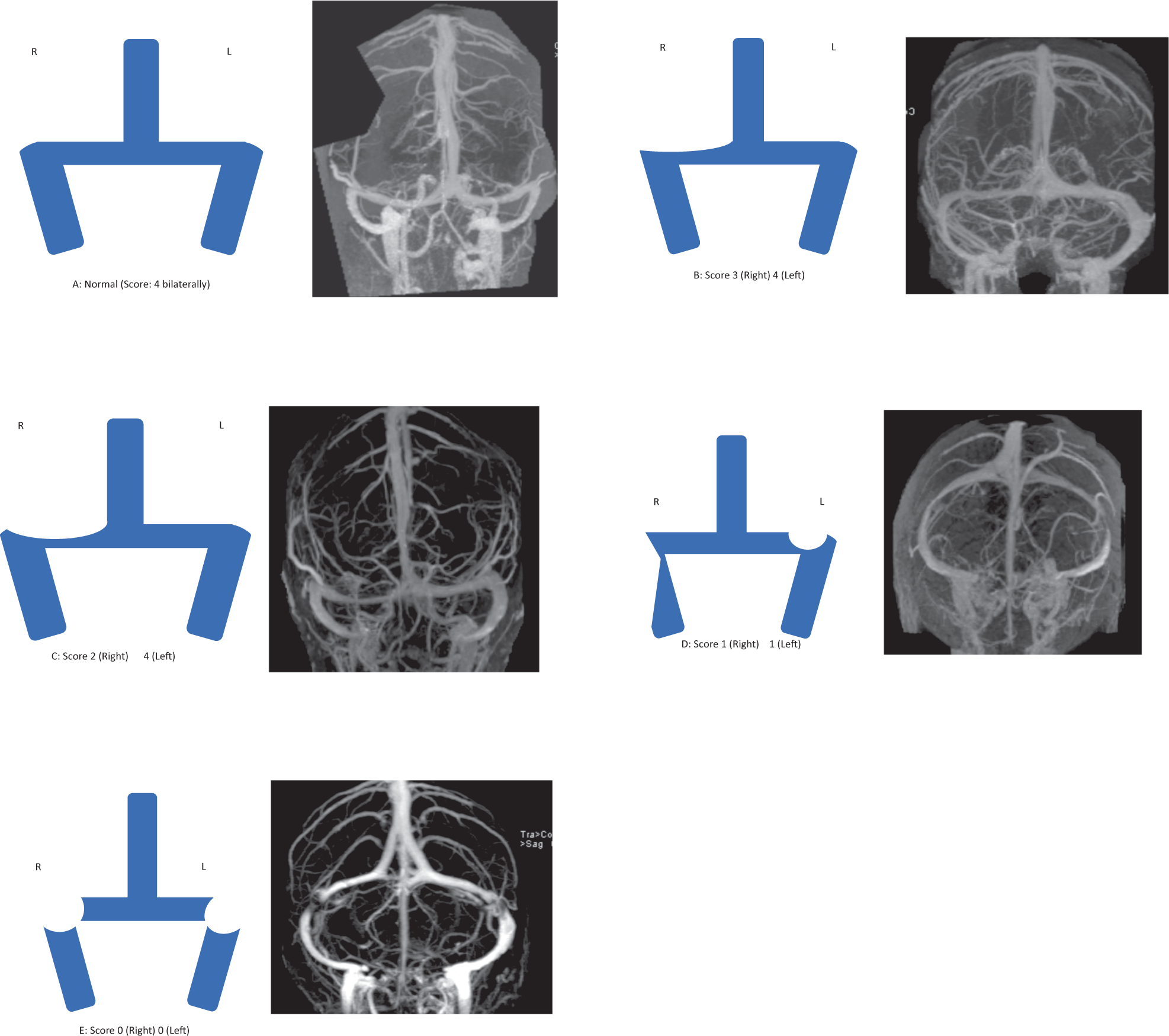 Extent of transverse sinus stenosis does not predict visual outcomes in  idiopathic intracranial hypertension | Eye