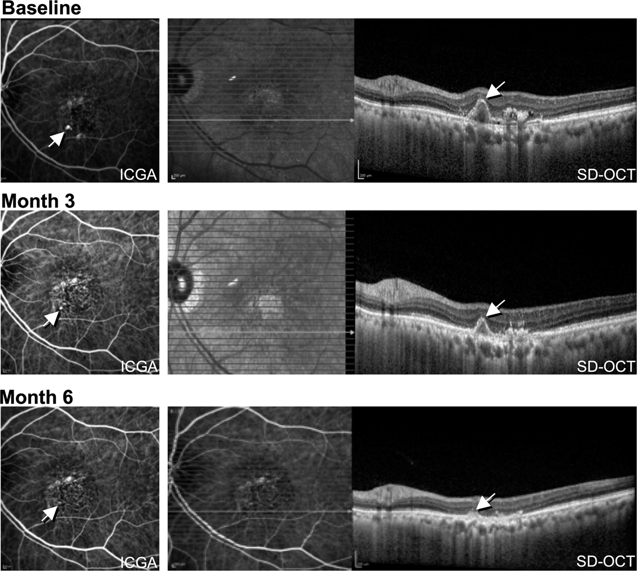 Evolving Treatment Paradigms For Pcv Eye Evolving Treatment Paradigms For Pcv Eye