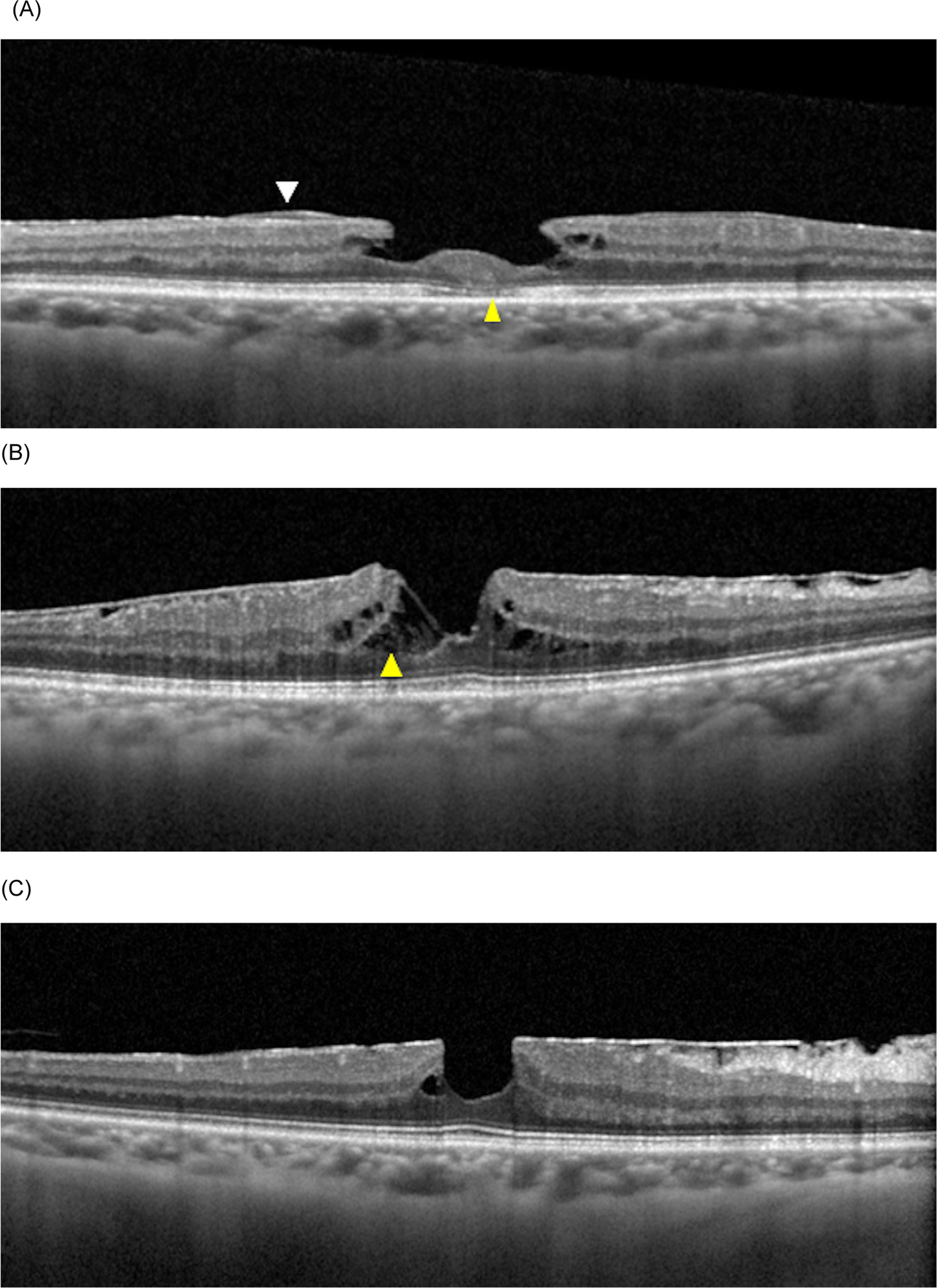 Foveal microstructure and visual function in patients with lamellar macular  hole, epiretinal membrane foveoschisis or macular pseudohole | Eye