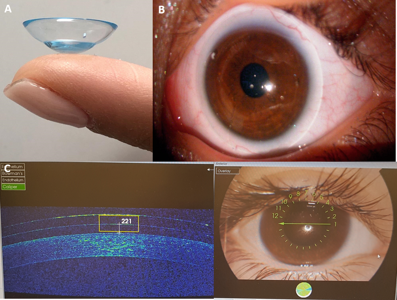 Assessment of long-term visual outcomes in aphakic children wearing scleral contact  lenses | Eye
