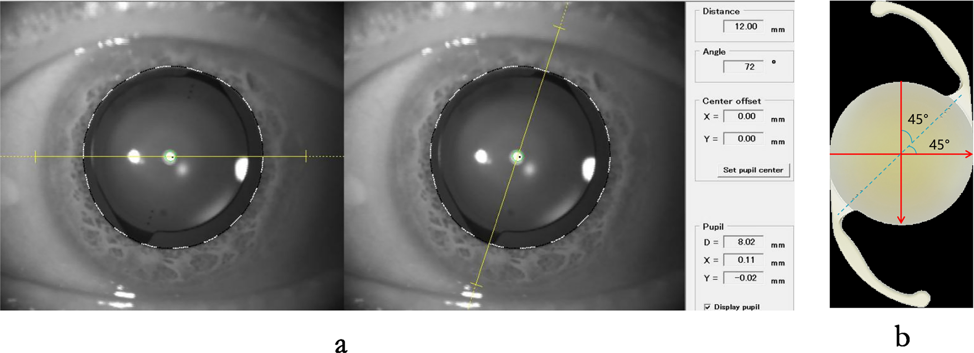 Frontiers | Insights into the rotational stability of toric intraocular  lens implantation: diagnostic approaches, influencing factors and  intervention strategies