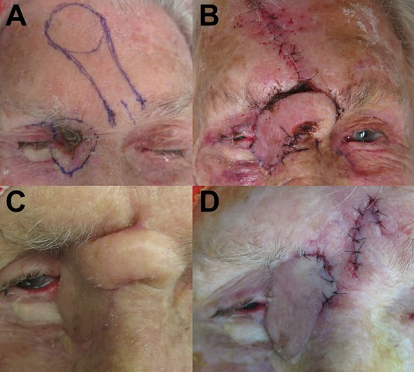 The use of the paramedian forehead flap alone or in combination with other  techniques in the reconstruction of periocular defects and orbital  exenterations | Eye