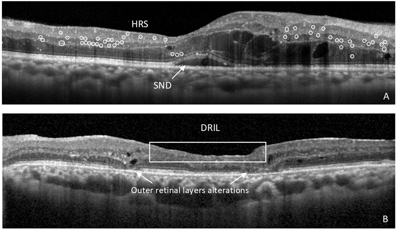 retinal layers oct
