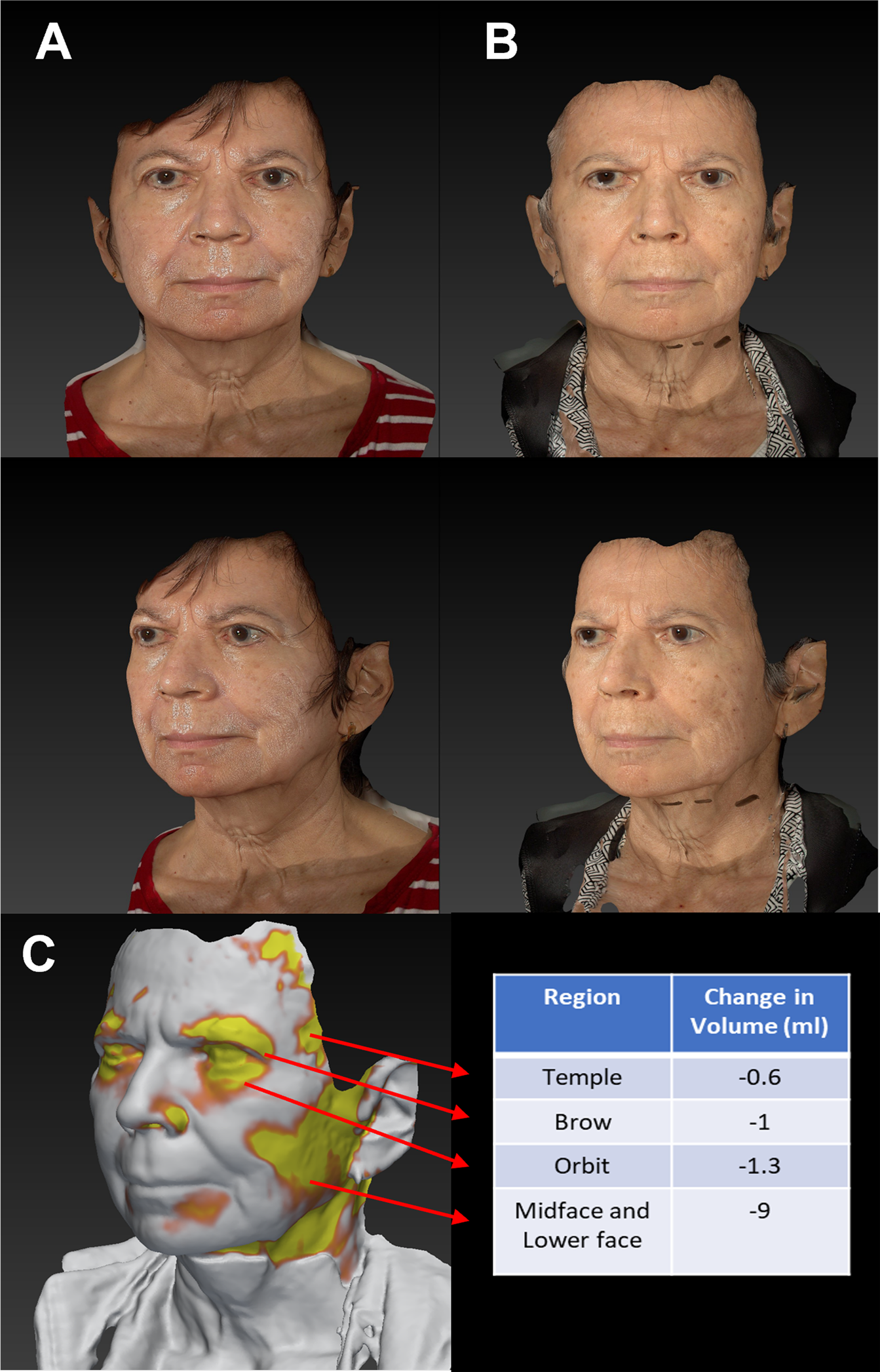 hypothyroidism before and after face