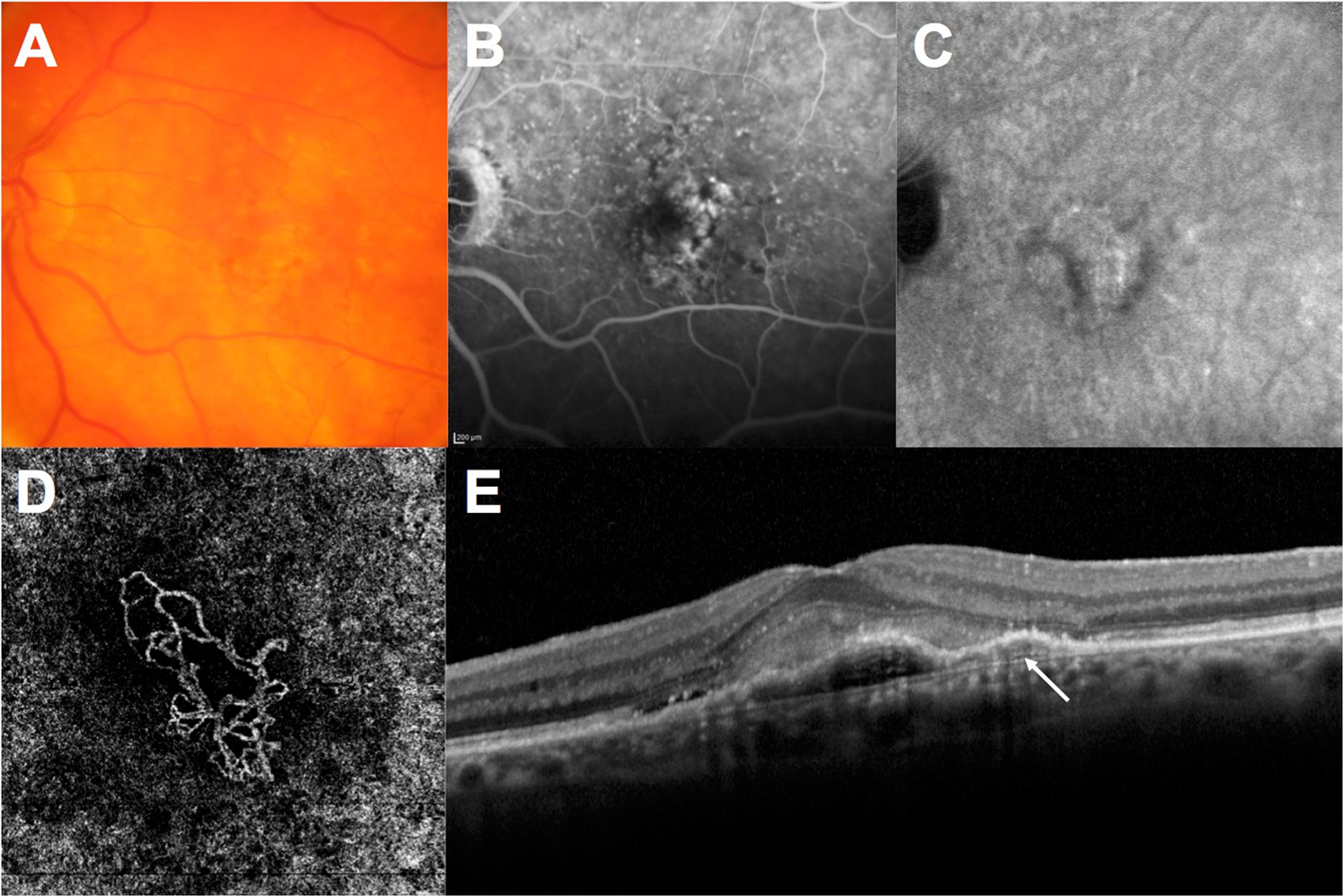 Characterisation Of Macular Neovascularisation Subtypes In Age Related Macular Degeneration To Optimise Treatment Outcomes Eye Characterisation Of Macular Neovascularisation Subtypes In Age Related Macular Degeneration To Optimise Treatment Outcomes Eye