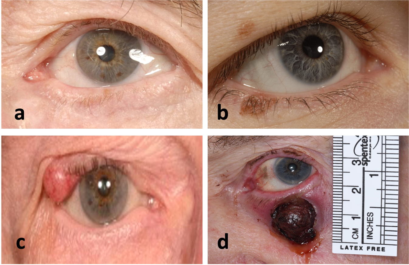 Long-term outcomes of margin-controlled excision for eyelid melanoma | Eye