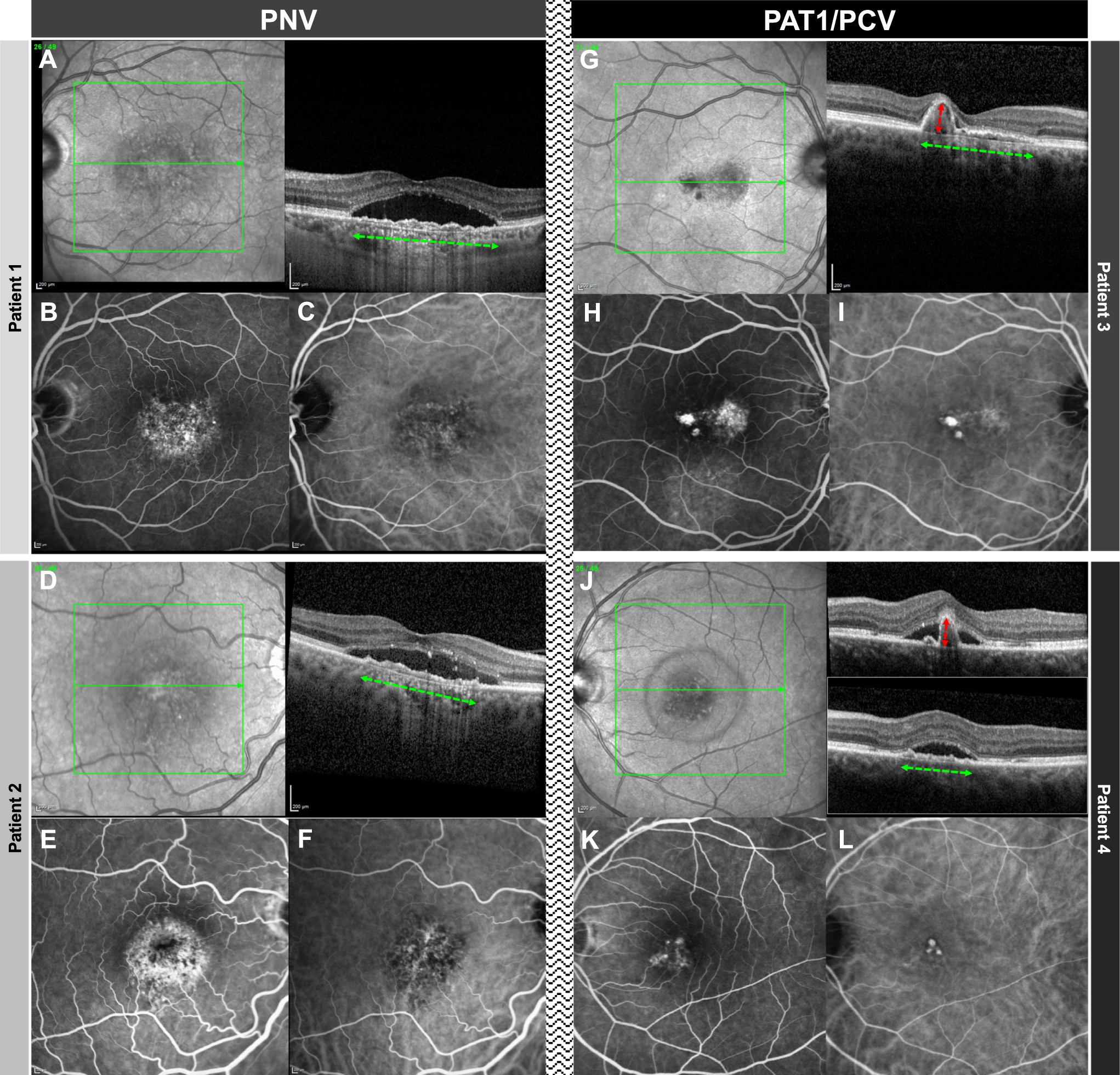 Fig. 1: Comparison of two cases PNV and two cases of PAT1/PCV.