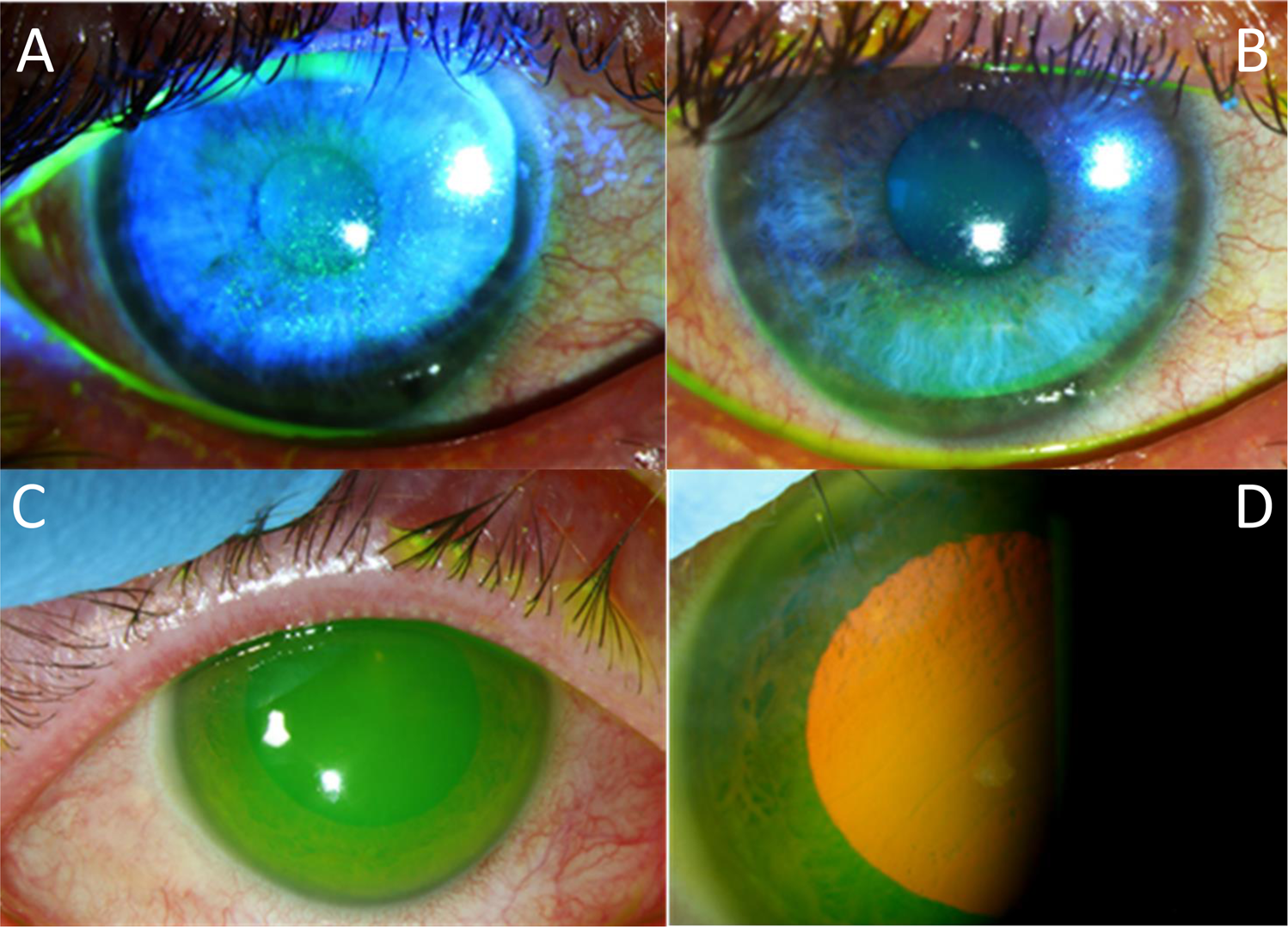 Fig. 1: Composite figure of anterior segment photographs of Epimax related ocular surface toxicity.