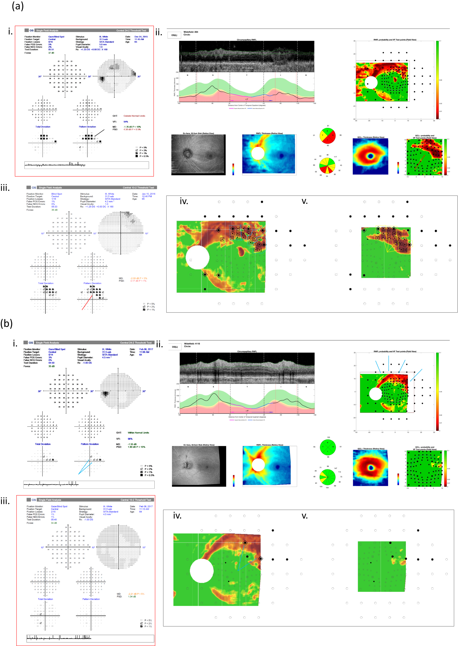 Fig. 3: Under-estimation of severity by a single visual field test due to missed central (a) or peripheral (b) involvement.
