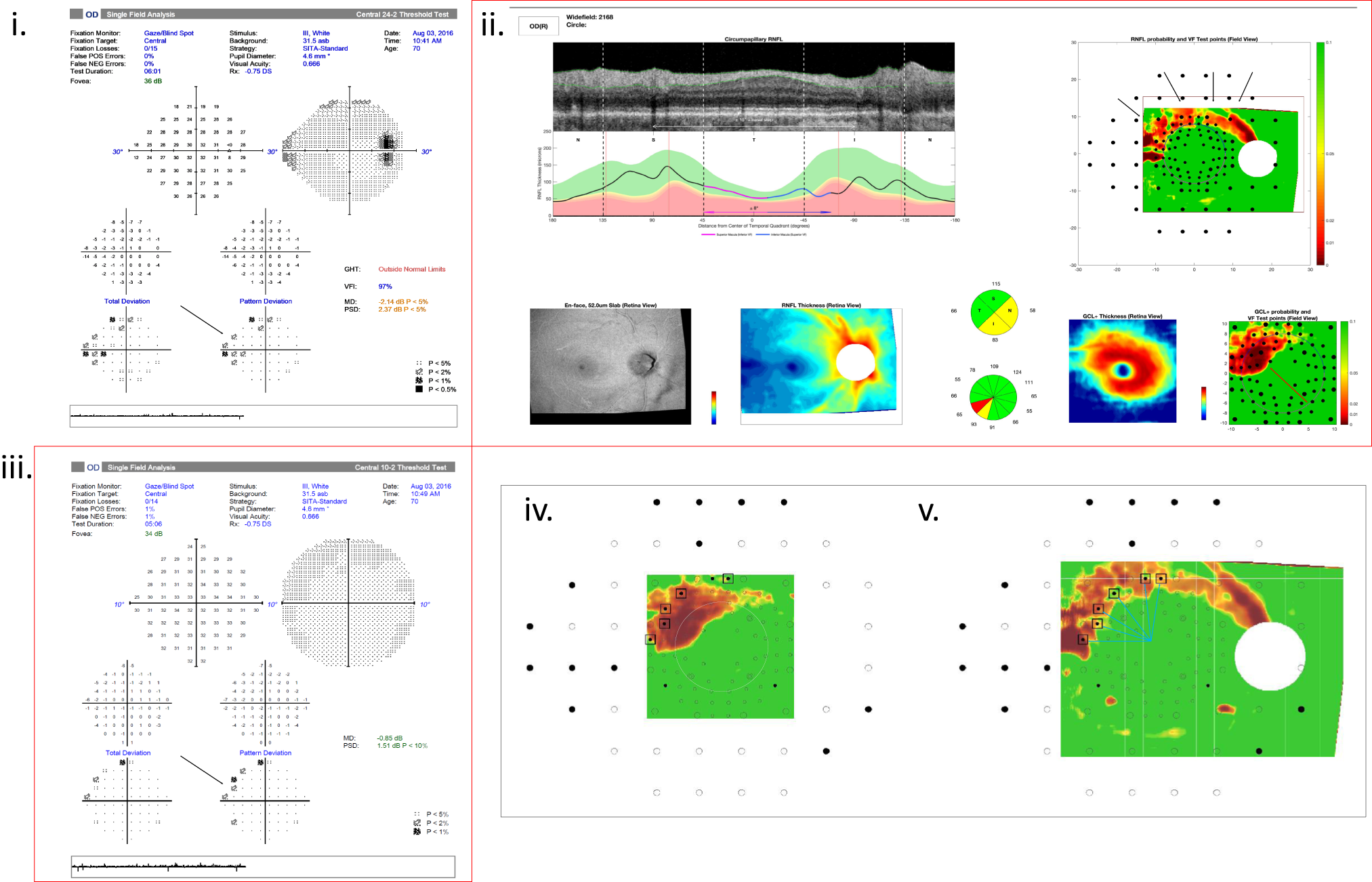 Fig. 4: Accurate estimation of severity by the 10-2 alone but over-estimation when combined with OCT.