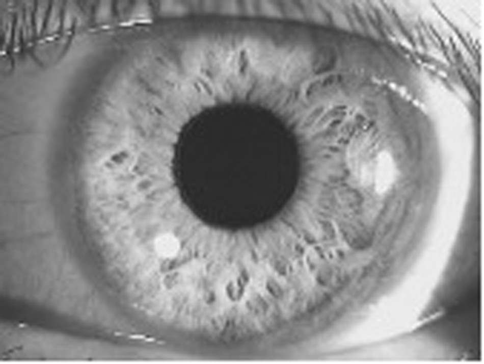 Fig. 1: showing a wide-open anterior angle with flashlight examination, as evident by the small shadow (banana shaped on left) indicating a flat iris.