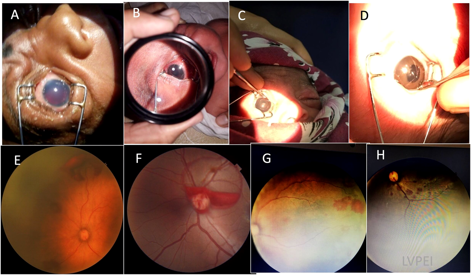 Common newborn vision screening methods
