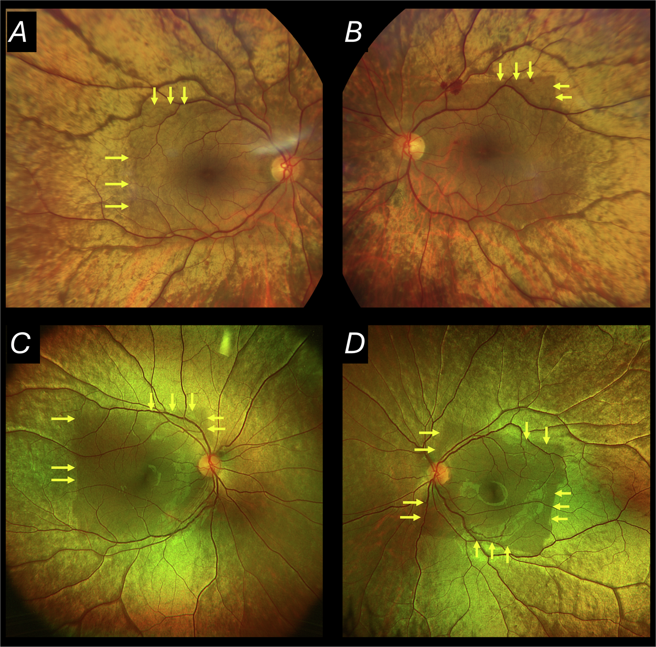 Fig. 1: Absence of sheen in area of prior 488 nm AF imaging.