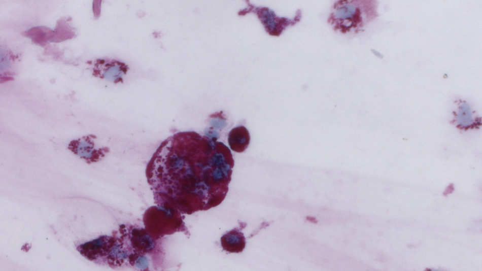 Fig. 3: PAS positive macrophages in vitreous fluid.