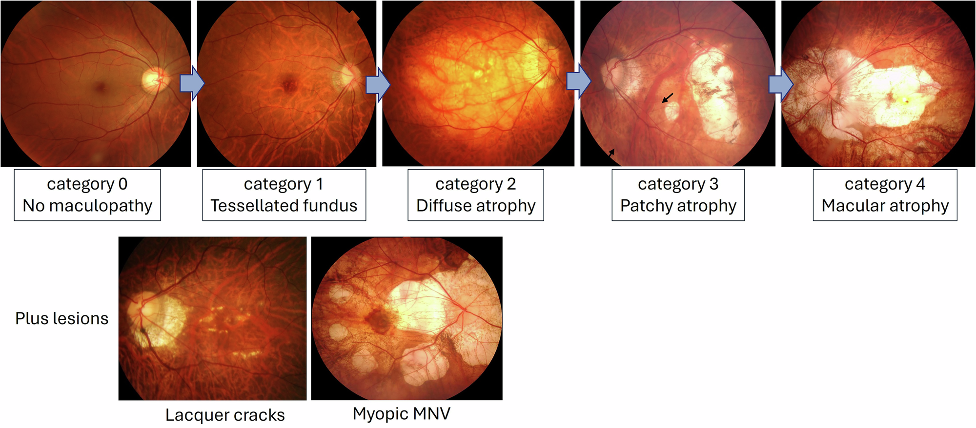 Pathologic myopia | Eye, image size:2000x878