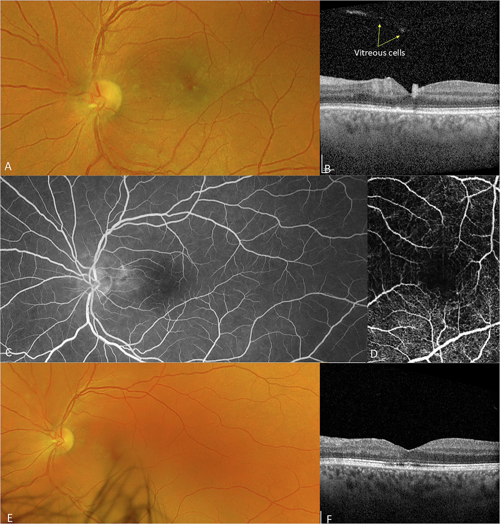 Punctate Inner Retinal Toxoplasmosis (PIRT): Multimodal Imaging | Eye