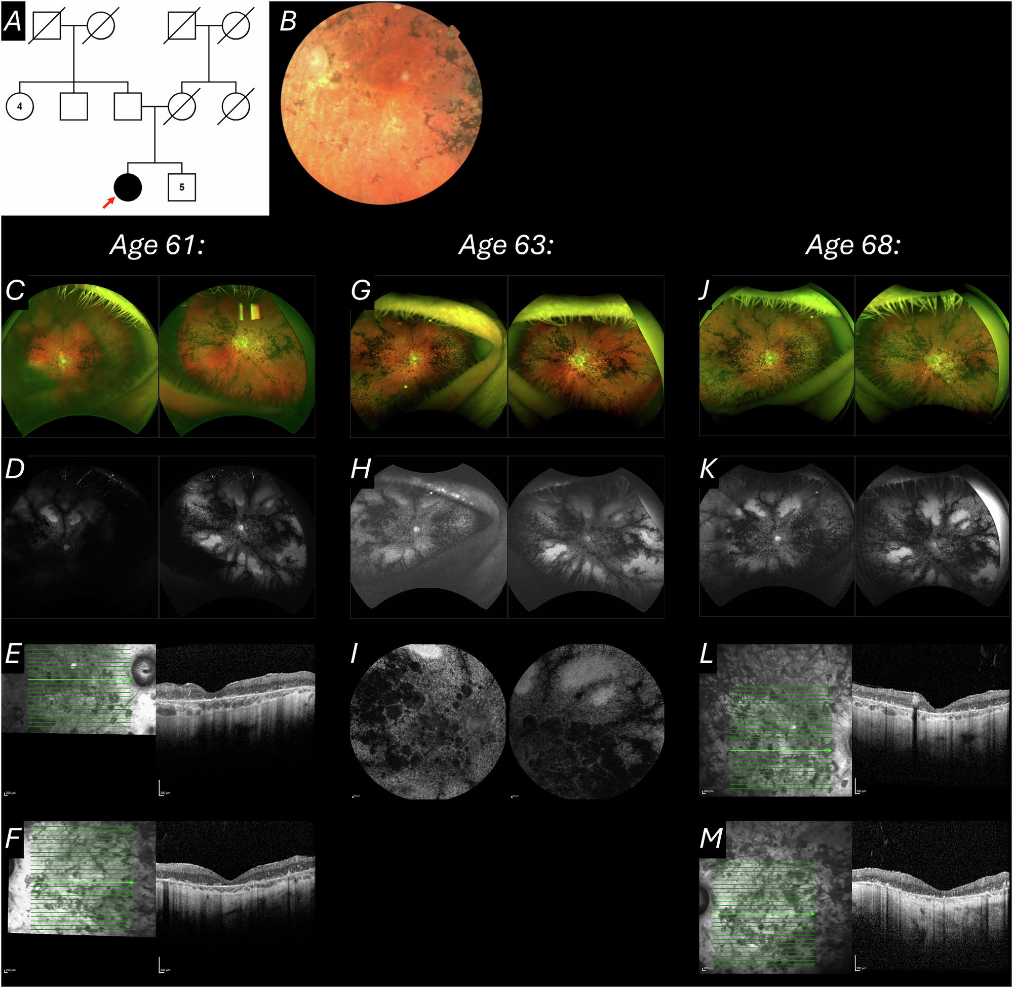 Fig. 3: Pedigree & multimodal imaging from Case 4.