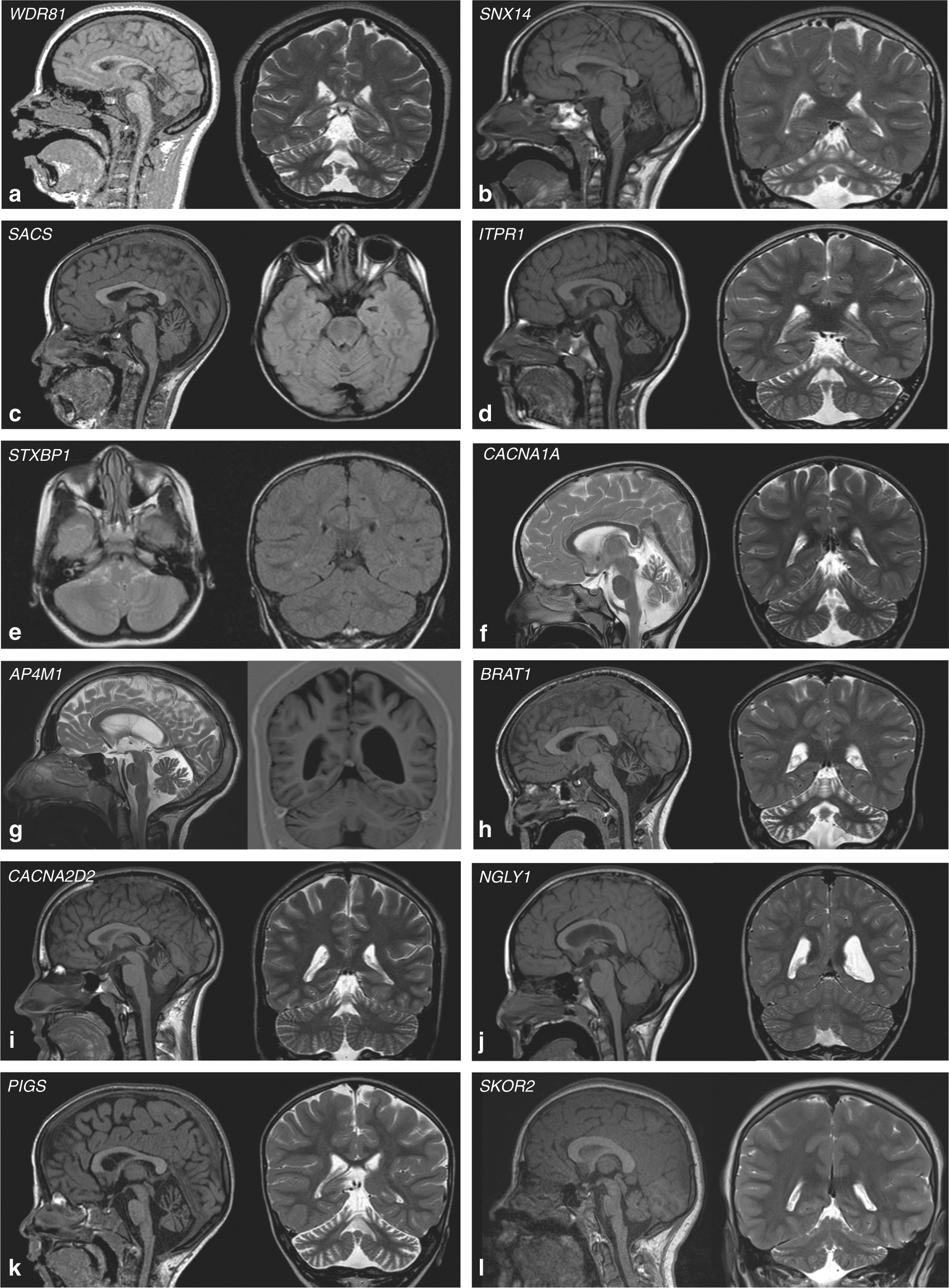 Exome Sequencing In Congenital Ataxia Identifies Two New Candidate Genes And Highlights A Pathophysiological Link Between Some Congenital Ataxias And Early Infantile Epileptic Encephalopathies Genetics In Medicine Exome Sequencing In Congenital Ataxia Identifies Two New Candidate Genes And Highlights A Pathophysiological Link Between Some Congenital Ataxias And Early Infantile Epileptic Encephalopathies Genetics In Medicine