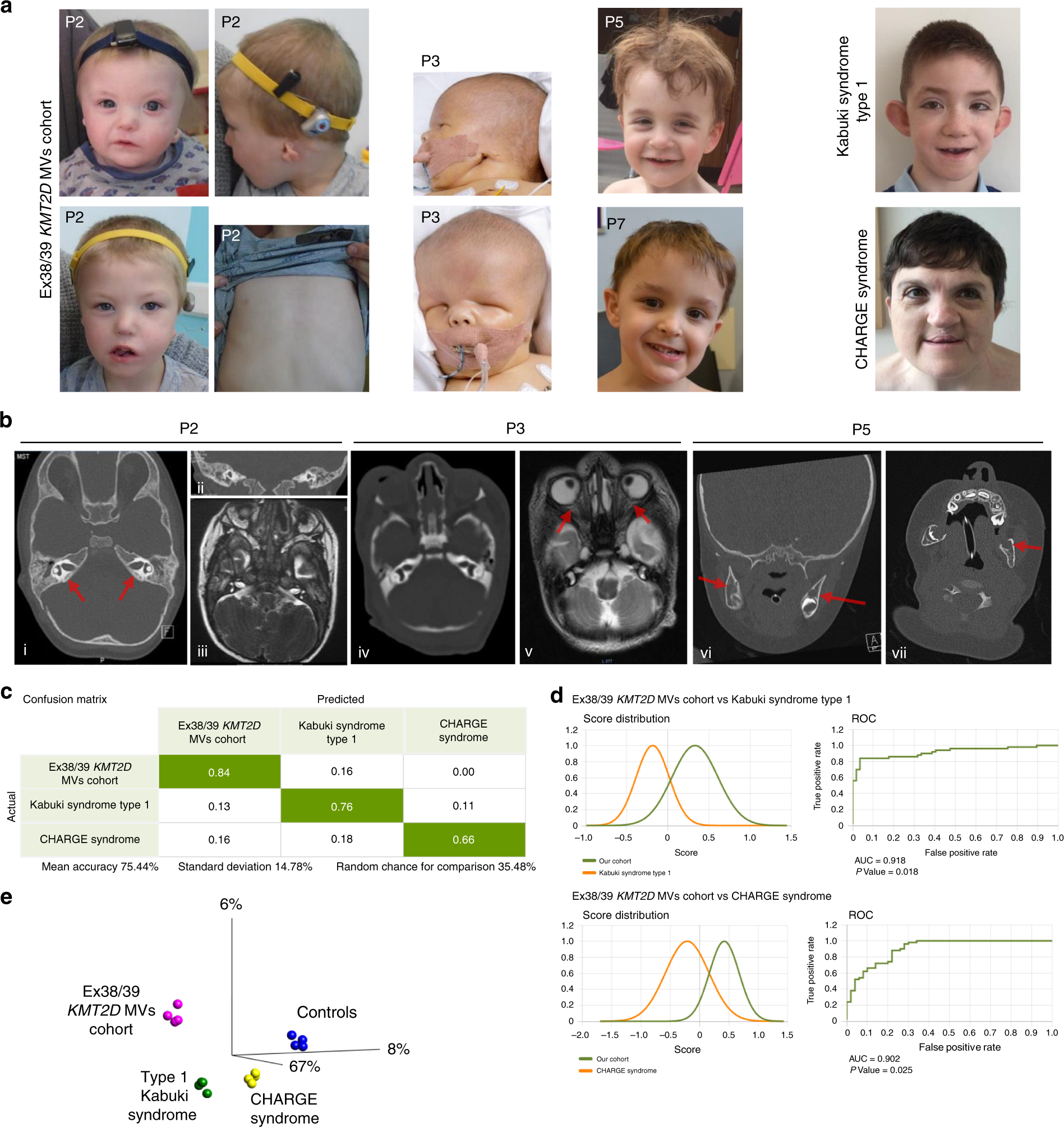 Fig. 2: Missense KMT2D variants
described in this study result in phenotype distinct from type 1
Kabuki and CHARGE syndromes.