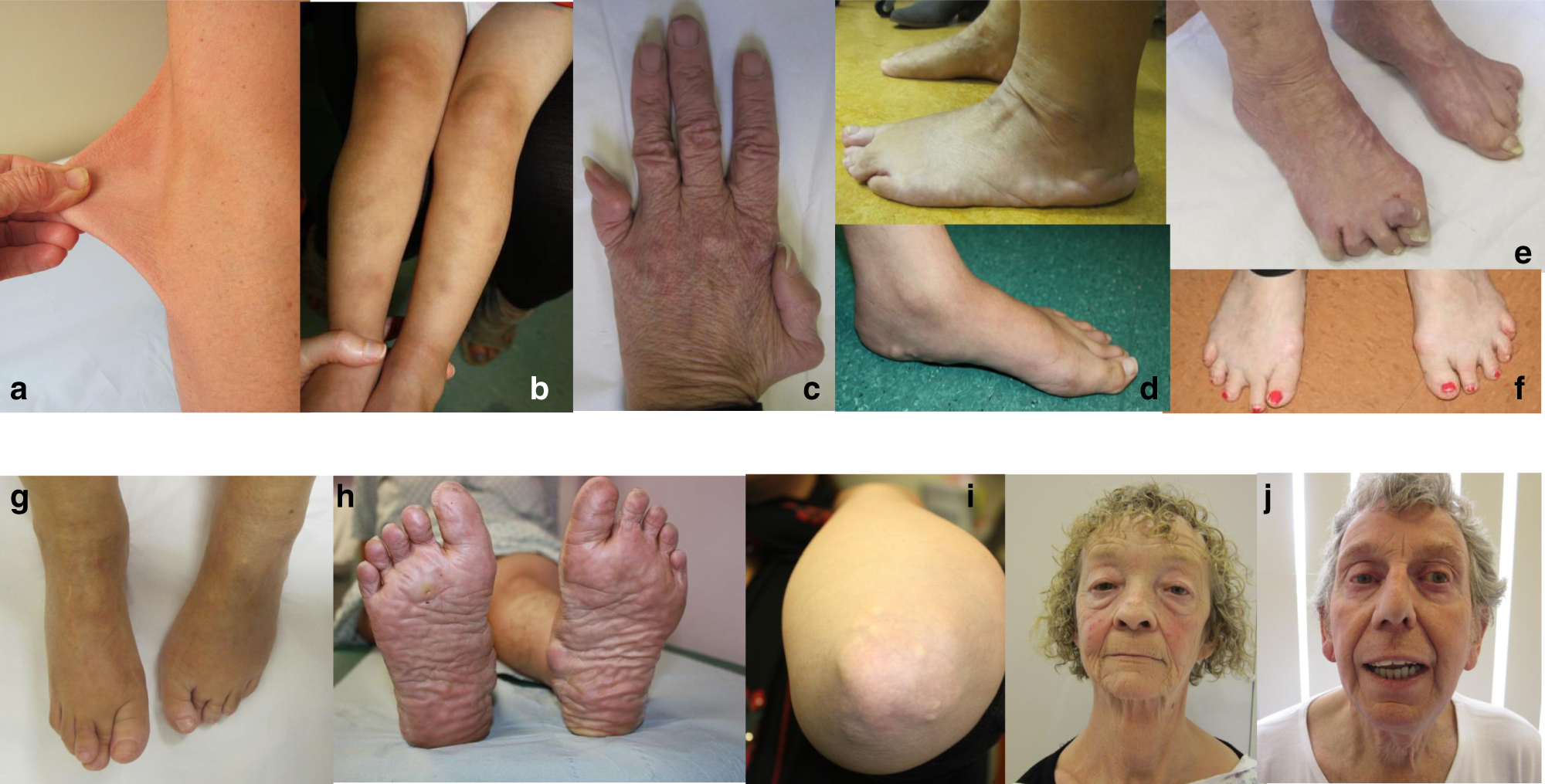 Fig. 1: Frequent and/or remarkable features in patients with classical-like Ehlers–Danlos syndrome (clEDS).