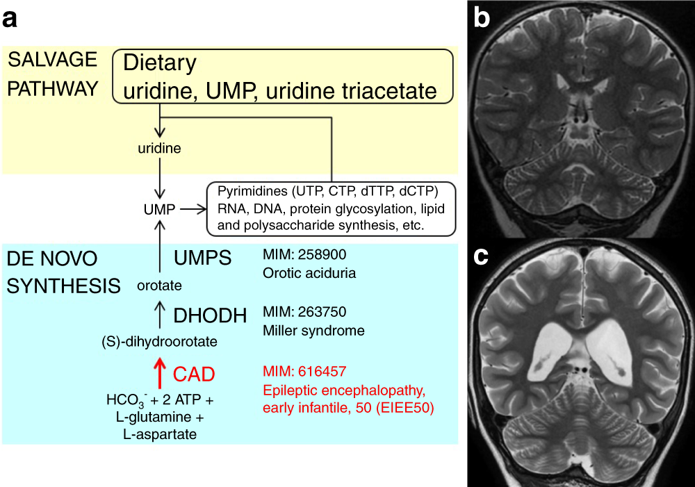 Expanding the clinical and genetic spectrum of CAD deficiency: an epileptic  encephalopathy treatable with uridine supplementation | Genetics in Medicine