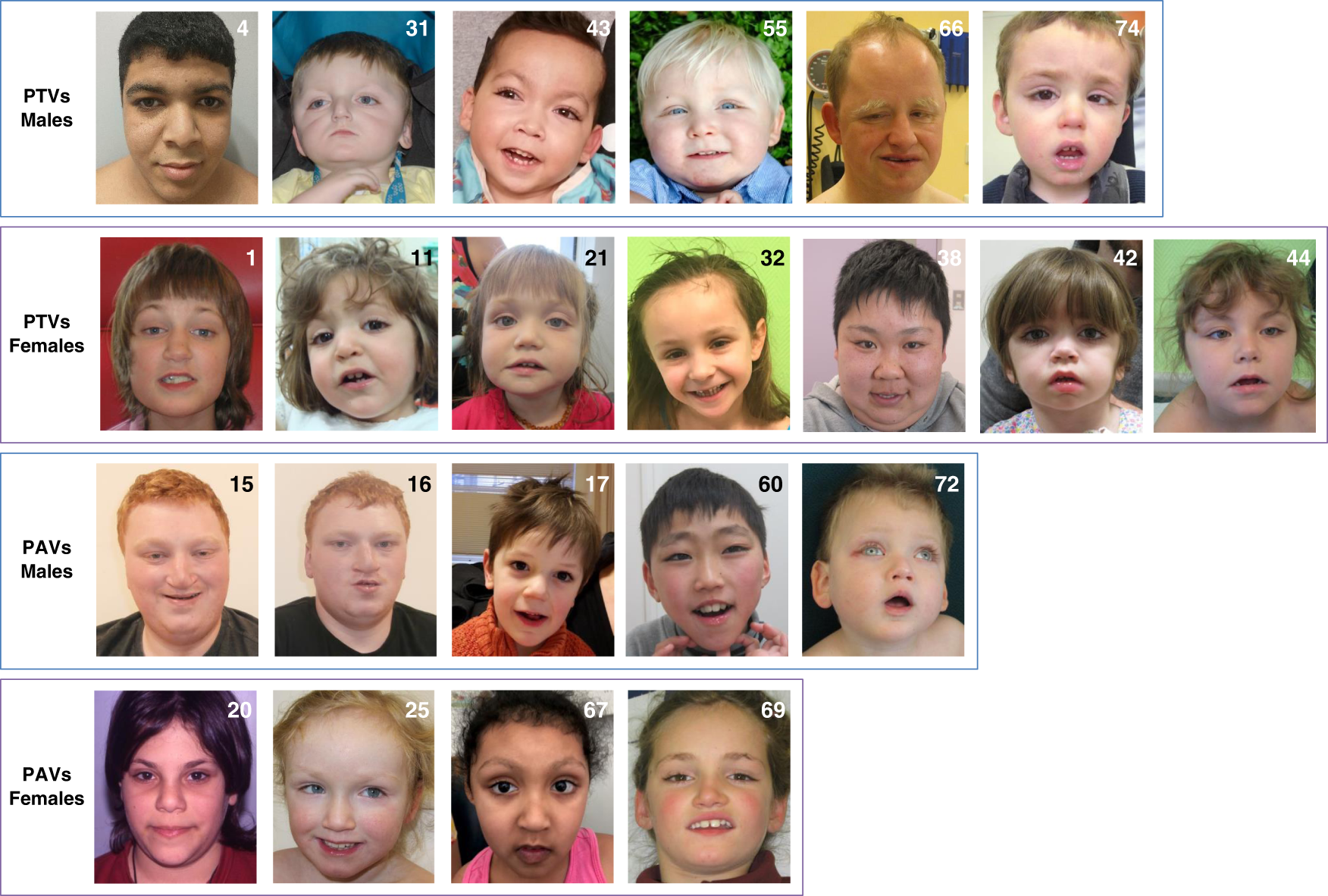 Fig. 2: Facial phenotypes of patients with KDM6A variants are highly variable.