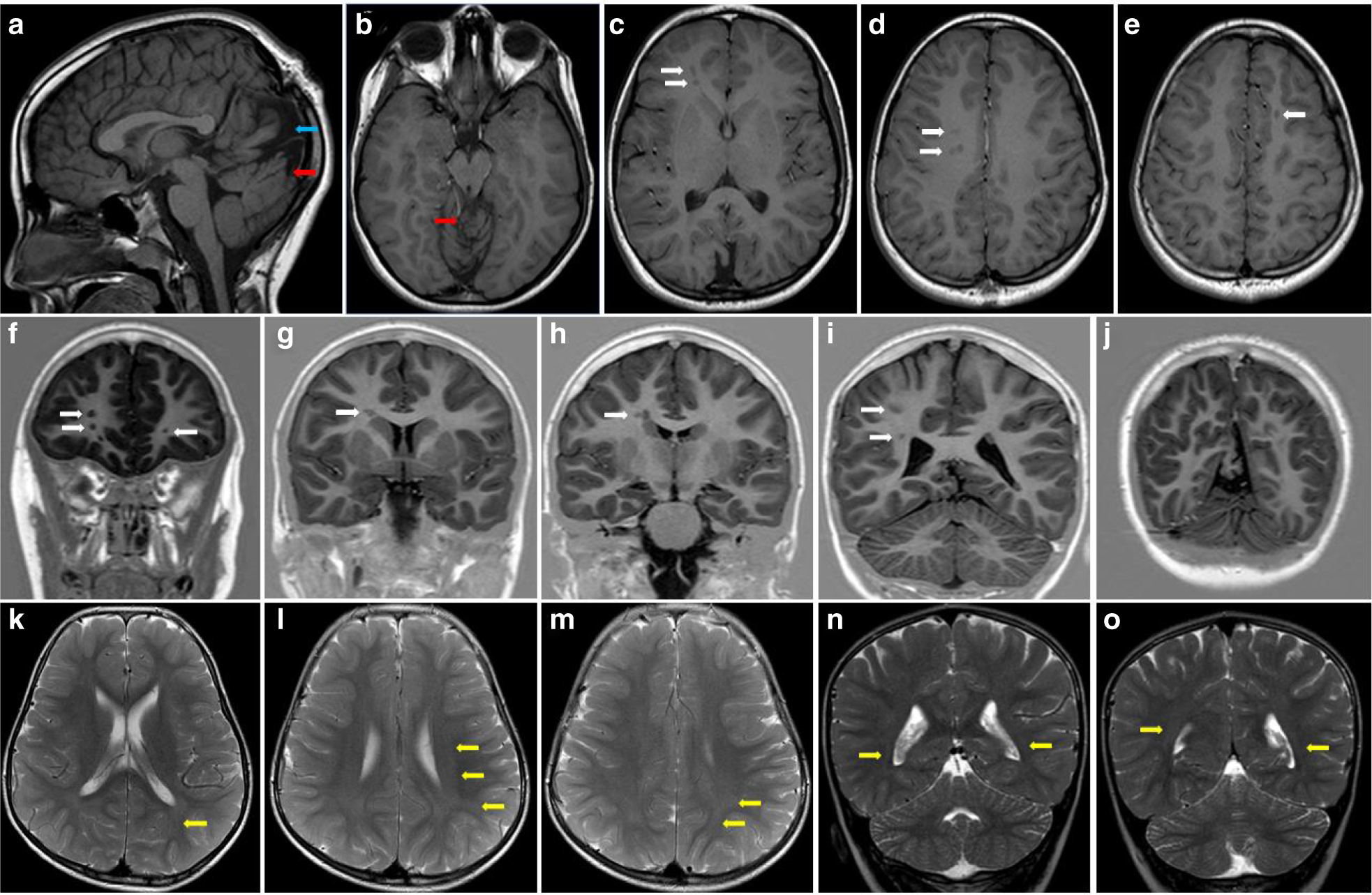 Fig. 3: Brain magnetic resonance image (MRI) affected individuals carrying expected-pathogenic variants in ARFGEF1.
