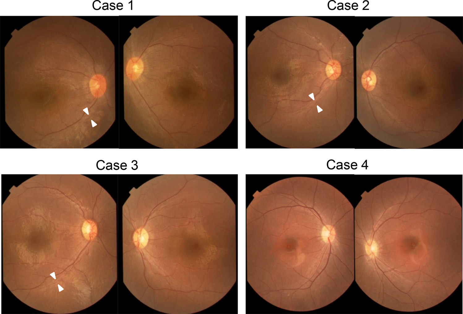 Fig. 1: Color fundus photographs of four patients with Leber’s congenital amaurosis (LCA) caused by RPGRIP1 mutations.