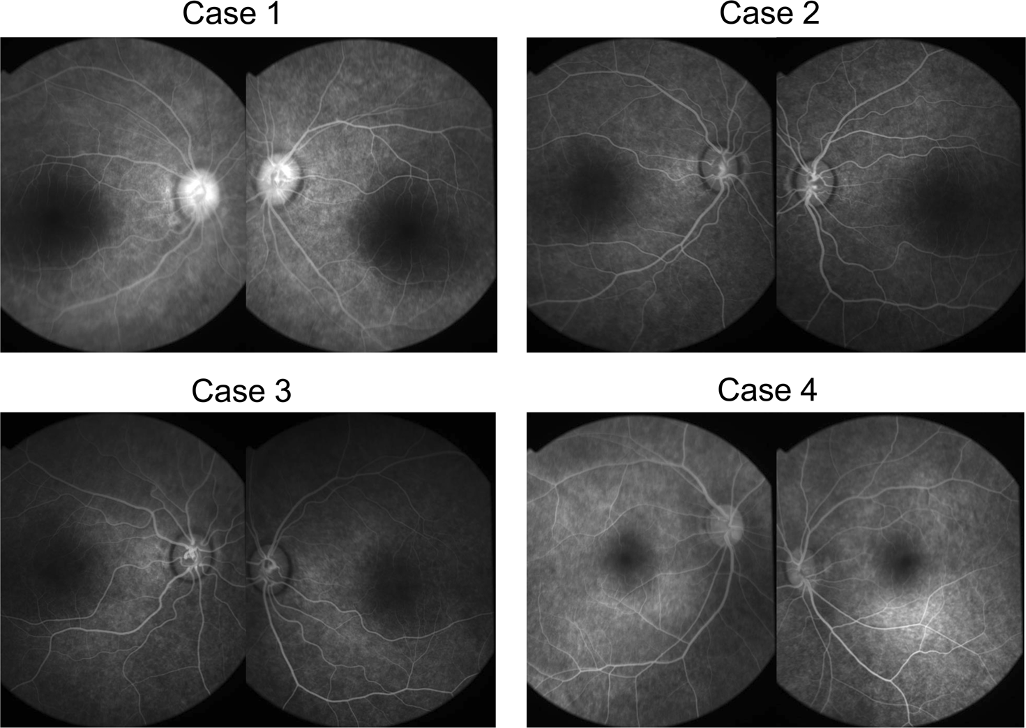 Fig. 2: Fluorescein angiographies (FA) of four patients with Leber’s congenital amaurosis (LCA) caused by RPGRIP1 mutations.