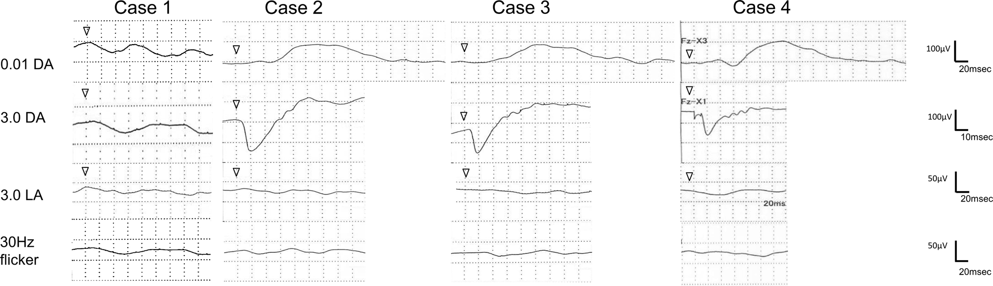 Fig. 3: Electroretinograms of four patients with Leber’s congenital amaurosis (LCA) caused by RPGRIP1 mutations.